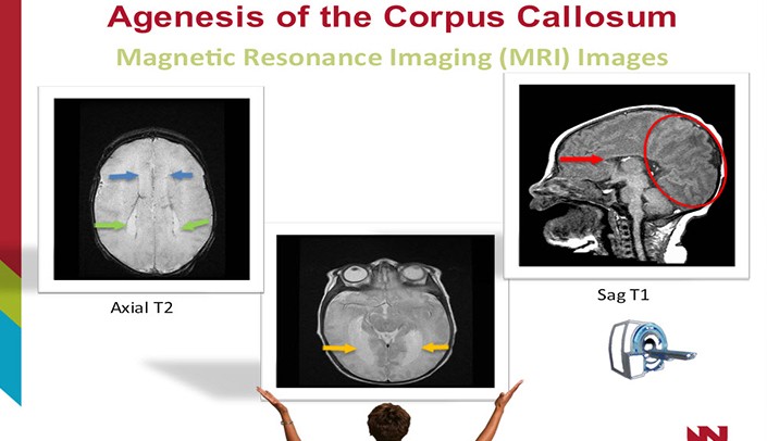 Agenesis Of Corpus Callosum Ultrasound