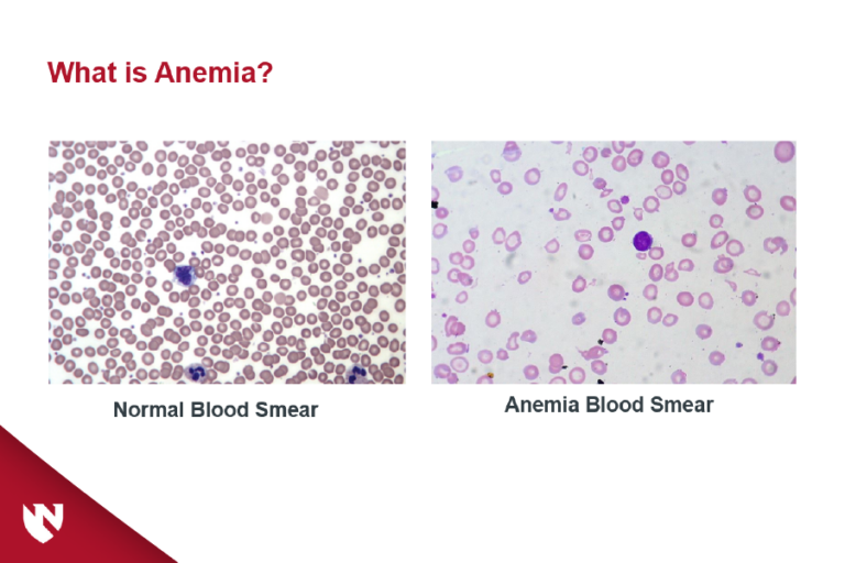 Pediatric Iron Deficiency Anemia EGallery University of Nebraska