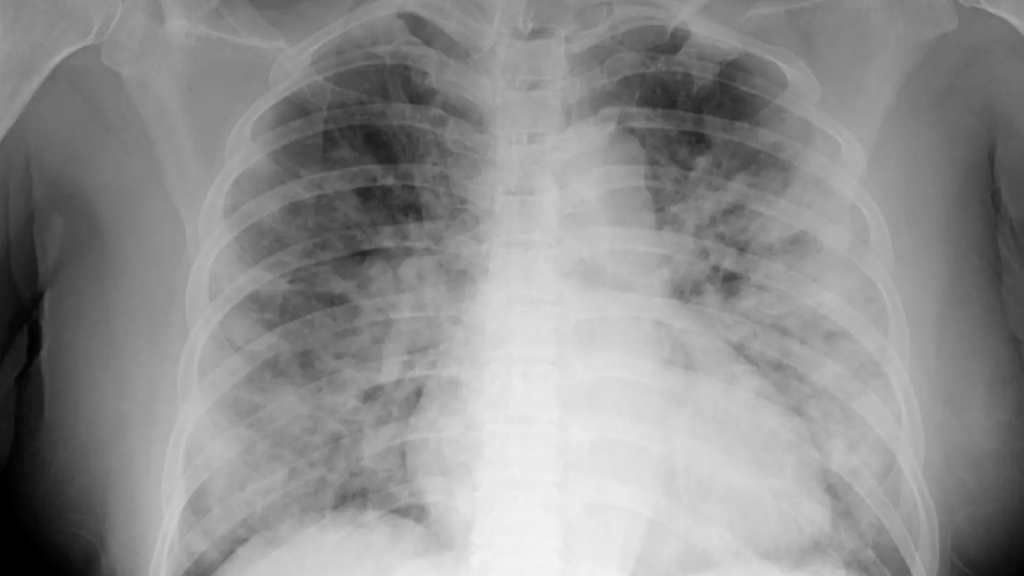 Chest CTs Reveal Abnormalities 2 Years After Severe COVID | The ...