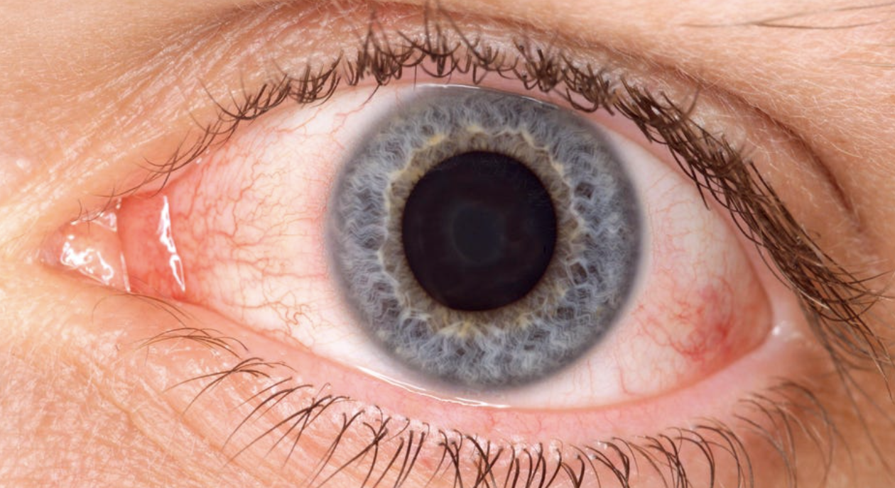 What To Know About ‘Arcturus’ New Covid Variant Causing Pink Eye The