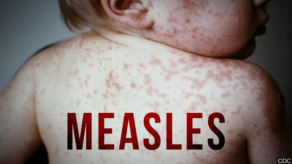 Cook Children's - A case of the measles has been confirmed