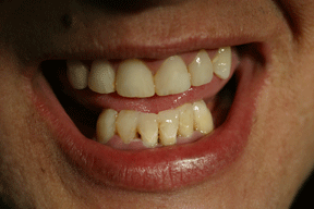 faces of meth teeth