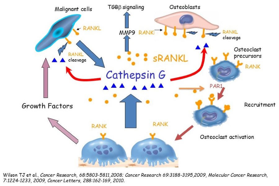 Bone Metastasis