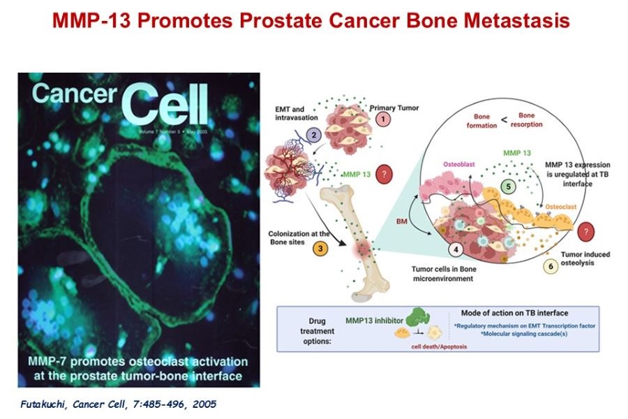 Prostate Cancer Bone Metastasis